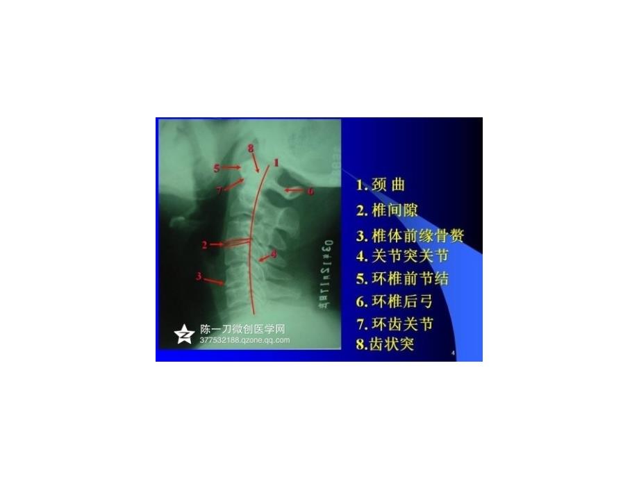 颈椎X光片学PPT课件.ppt_第3页