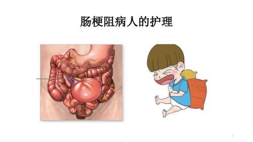 肠梗阻病人的护理ppt演示课件.pptx