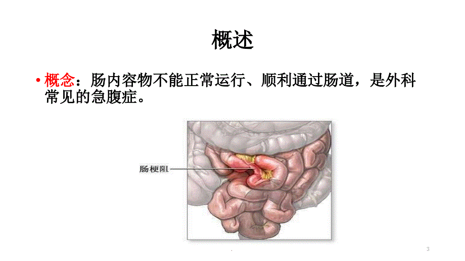 肠梗阻病人的护理ppt演示课件.pptx_第3页