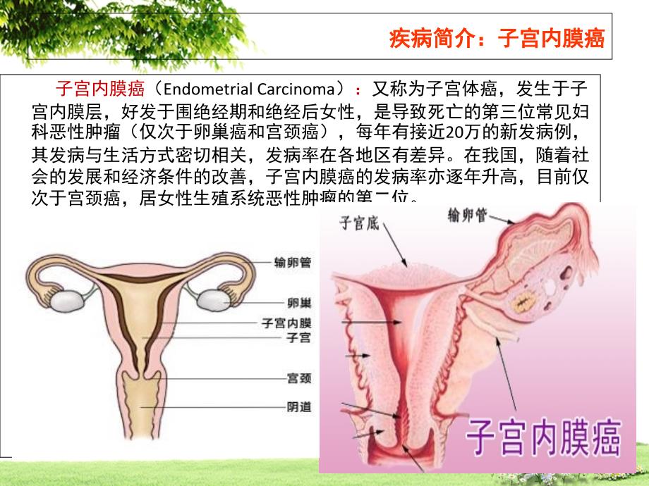 子宫内膜癌术后护理查房.ppt_第3页