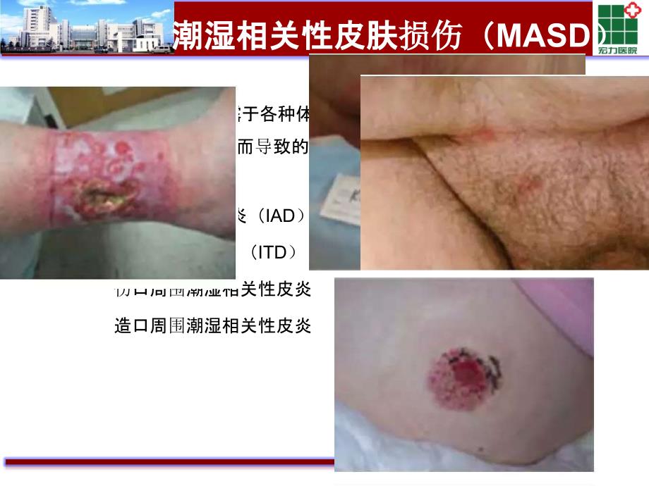 失禁性皮炎PPT课件.ppt_第3页