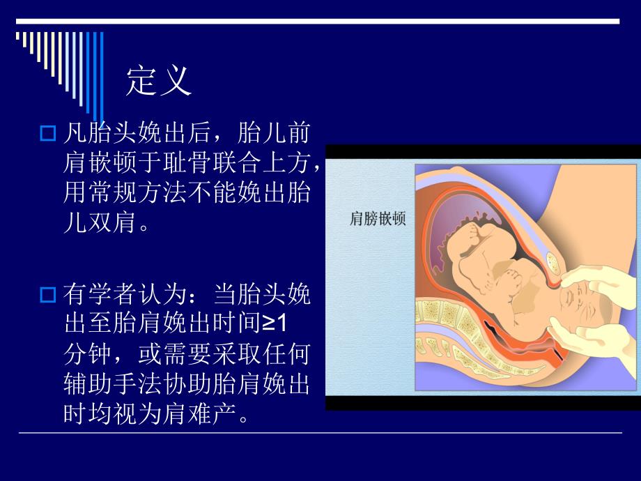 肩难产的紧急处理PPT课件.ppt_第3页