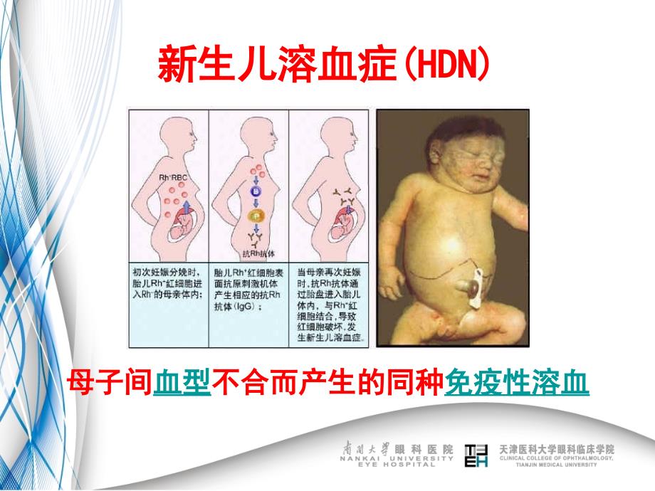 Rh血型不合引起新生儿溶血发病机制.ppt_第2页