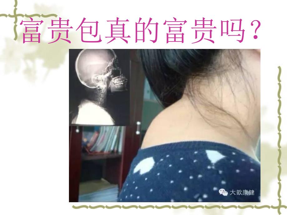 富贵包形成原因及治疗方法.ppt_第2页