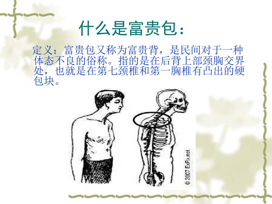 富贵包形成原因及治疗方法.ppt_第3页