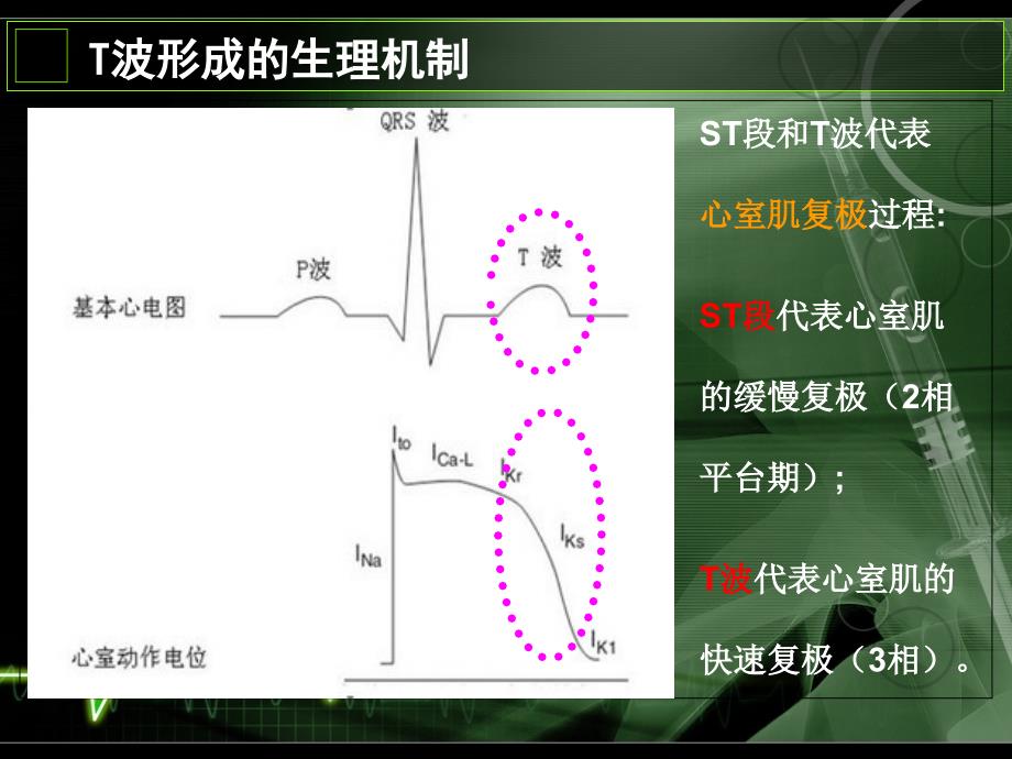 T波倒置的认识与诊断年金华心血管年会.ppt_第2页
