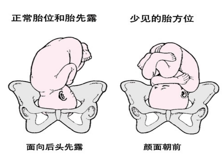 万艳枕后位个案ppt课件.ppt_第2页