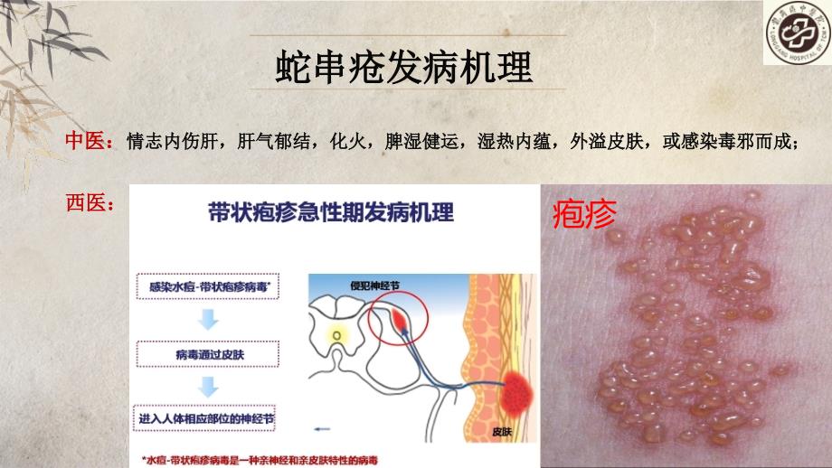 一例蛇串疮患者个案护理.pptx_第3页