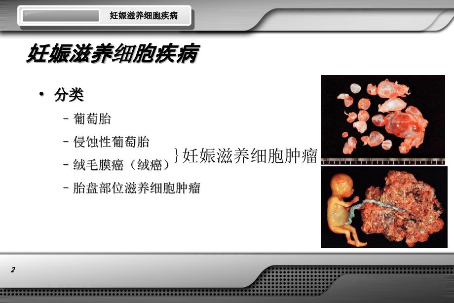 妊娠滋养细胞疾病.ppt_第2页