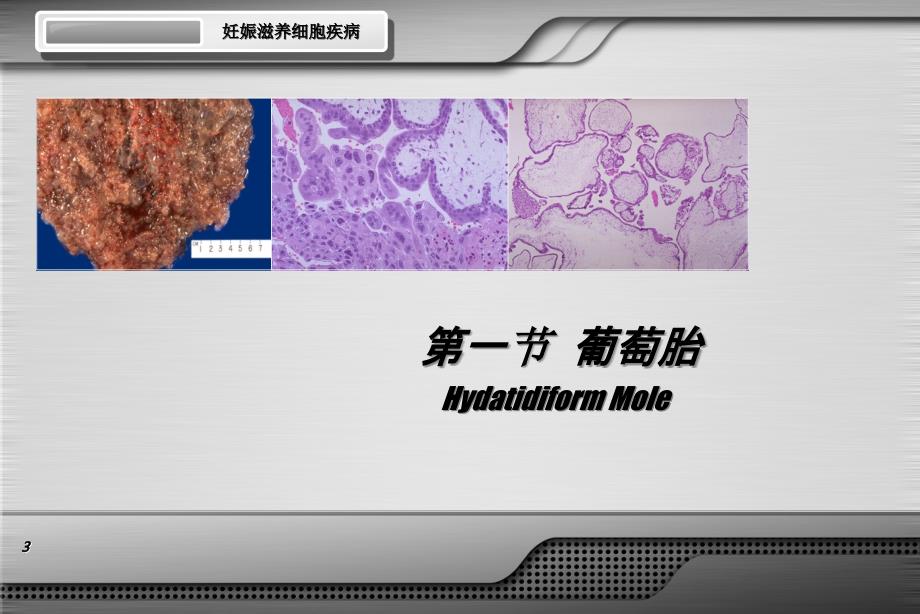 妊娠滋养细胞疾病.ppt_第3页
