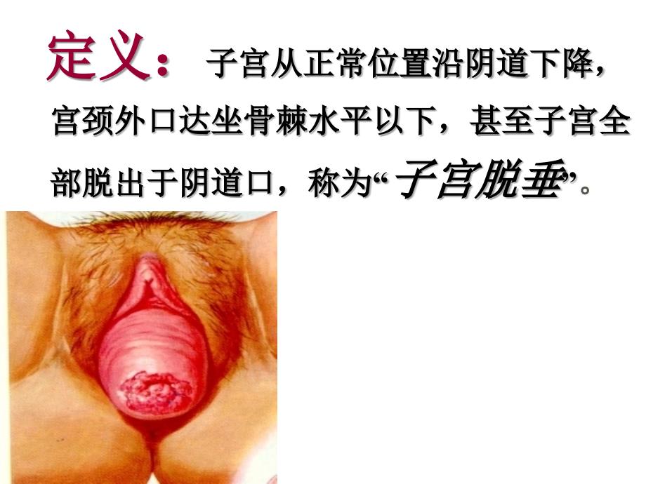 子宫脱垂ppt课件.ppt_第3页