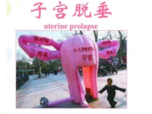 子宫脱垂ppt课件.ppt