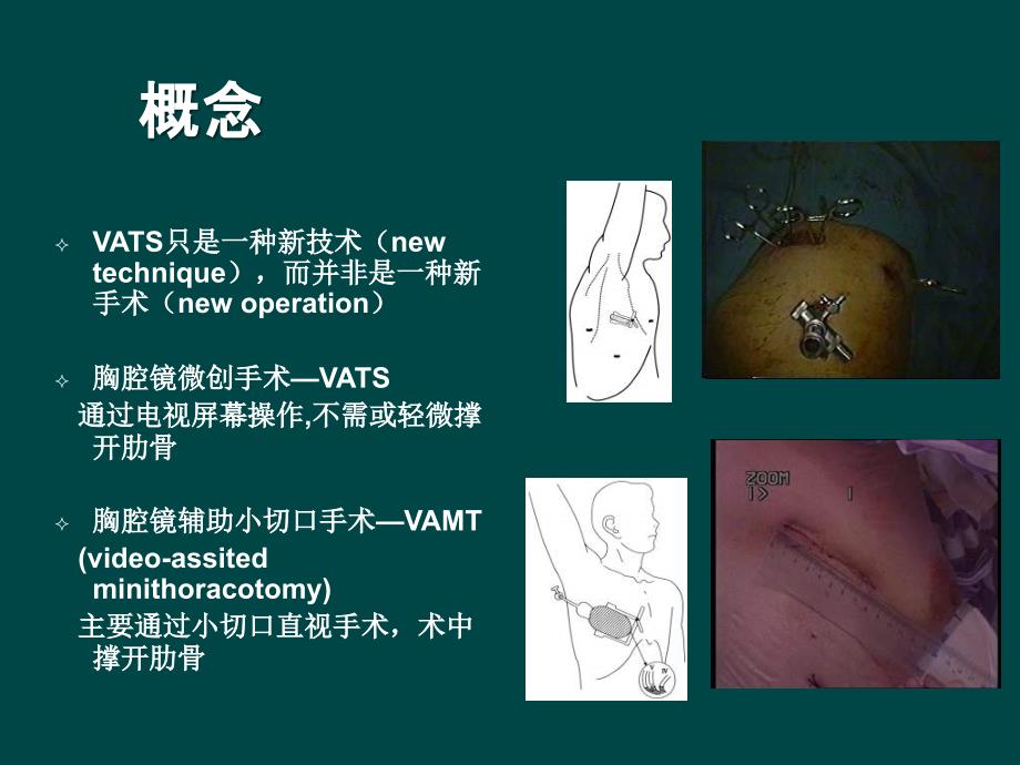 电视胸腔镜手术在胸心外科疾病诊治中的应用进展PPT课件.ppt_第3页
