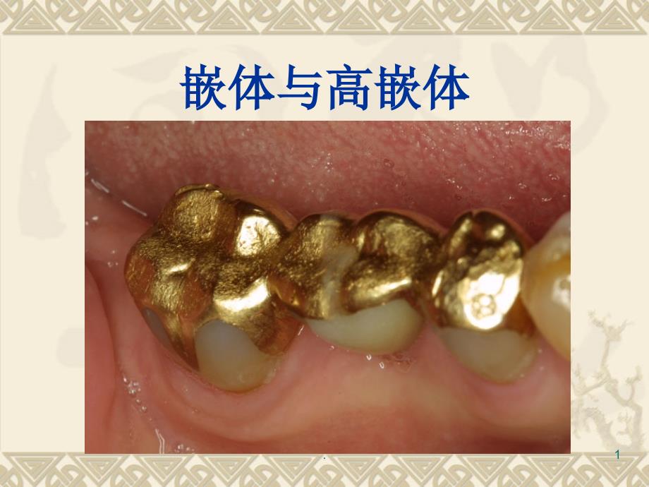 嵌体与高嵌体.PPT.ppt_第1页