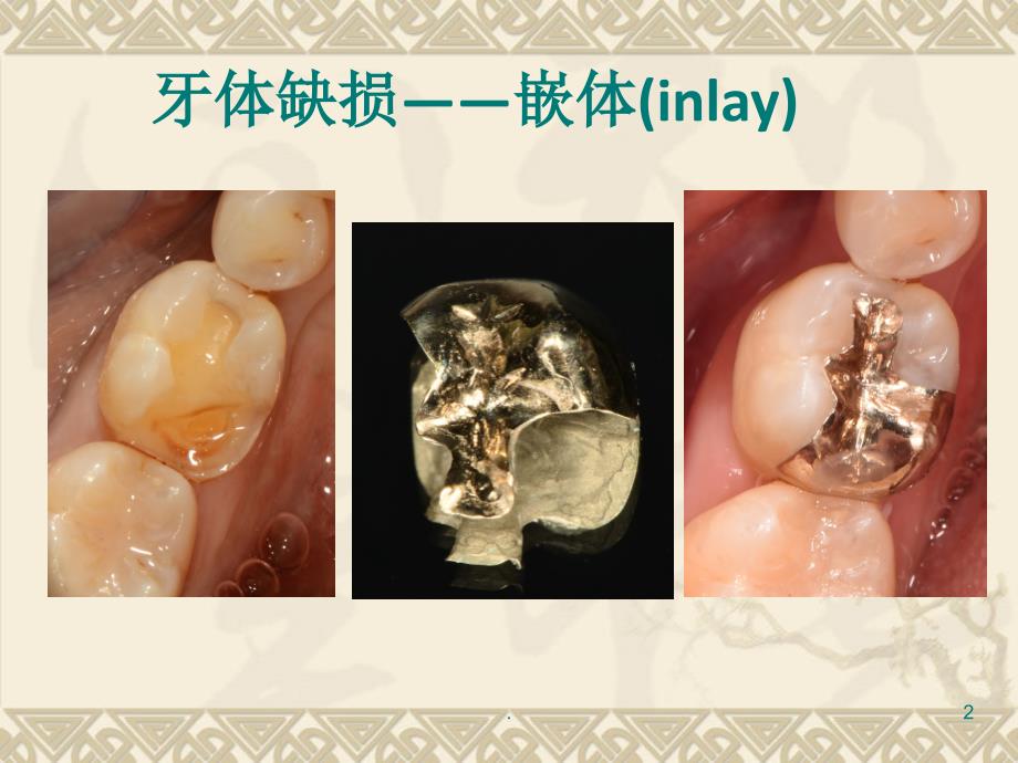 嵌体与高嵌体.PPT.ppt_第2页