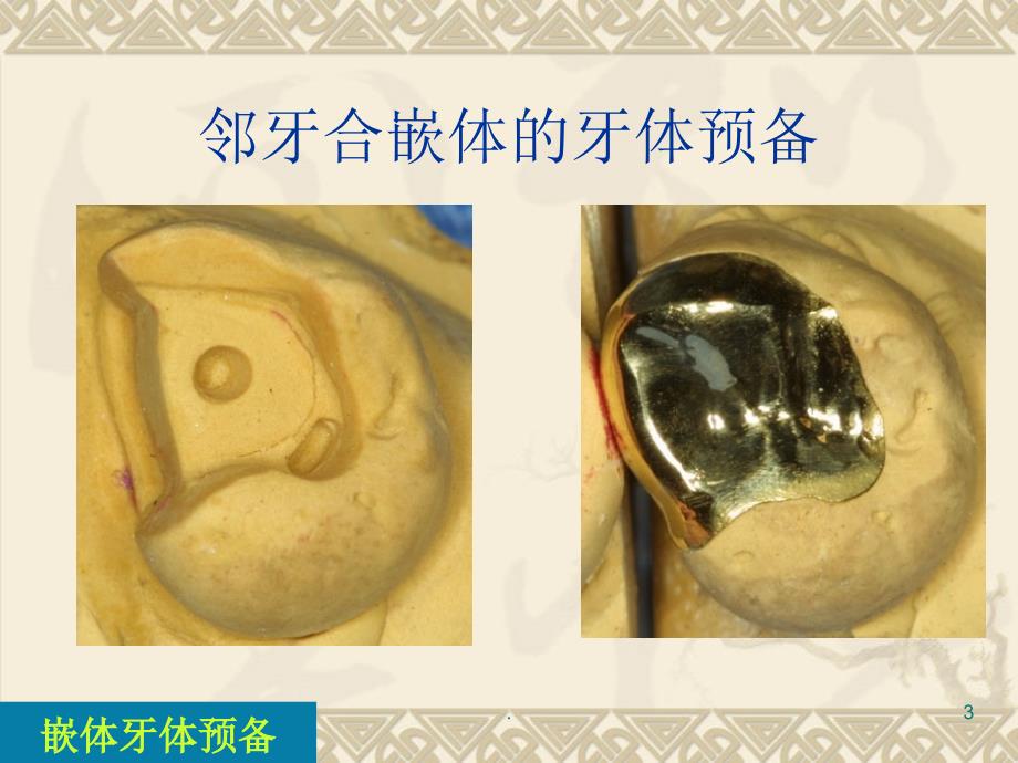 嵌体与高嵌体.PPT.ppt_第3页