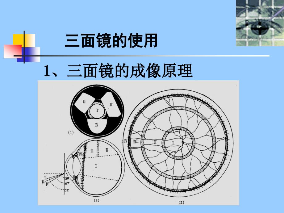 眼底检查三面镜检查眼科研究生课件.ppt_第3页