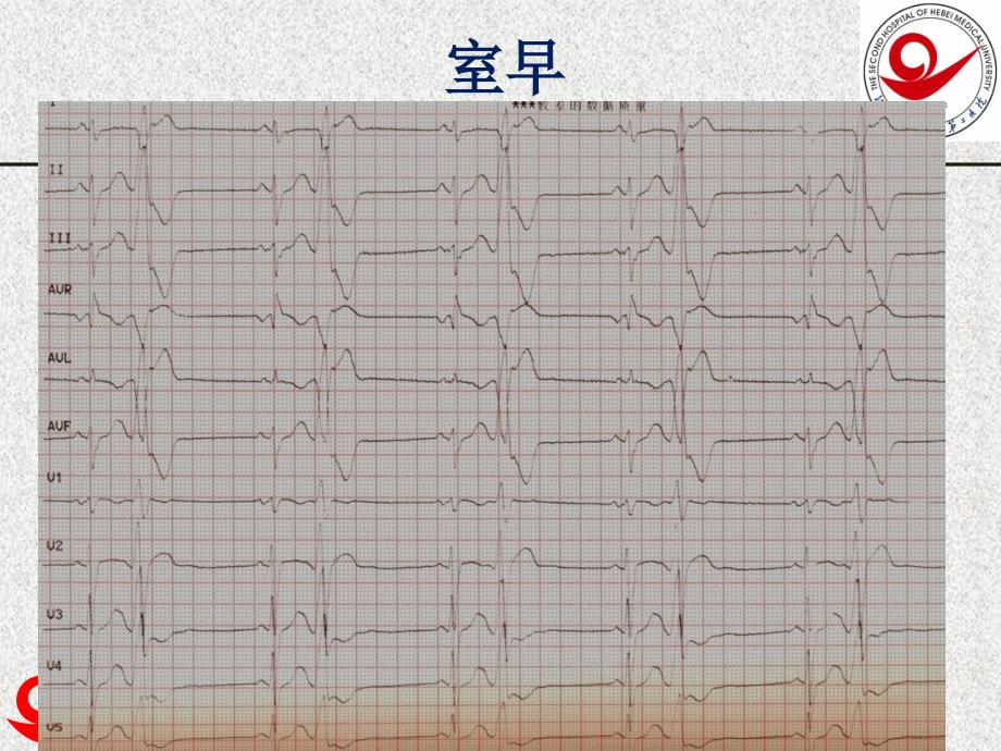 室早射频消融的病例选择和治疗策略.ppt_第2页