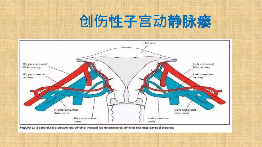 子宫动静脉瘘PPT课件.ppt_第1页