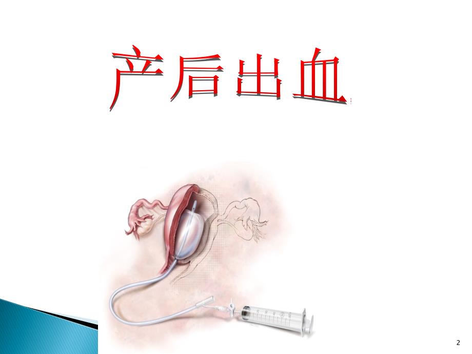 宫腔止血球囊PPT课件.ppt_第2页