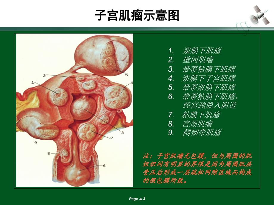 子宫肌瘤的超声诊断课件.ppt_第3页