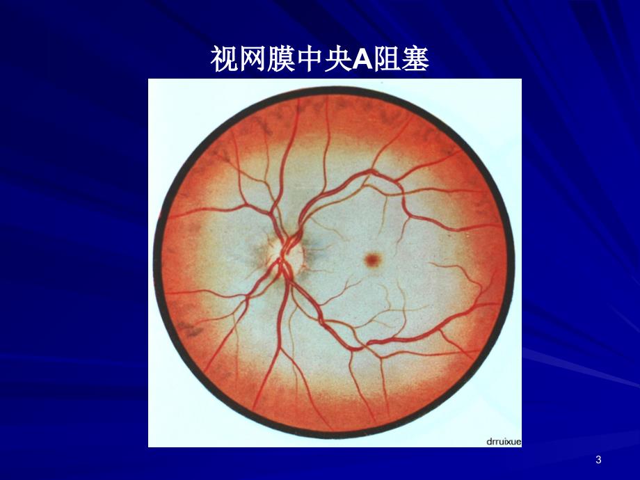 眼底病图谱ppt课件.ppt_第3页