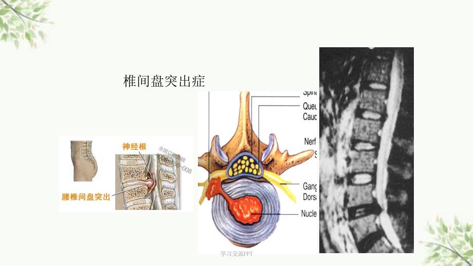 一次性纤维环缝合器ppt课件.ppt_第3页
