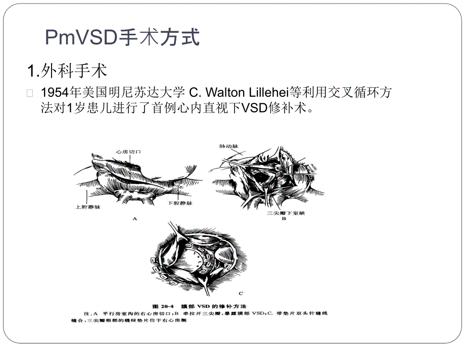 室间隔缺损术后完全性房室传导阻滞.pptx_第3页