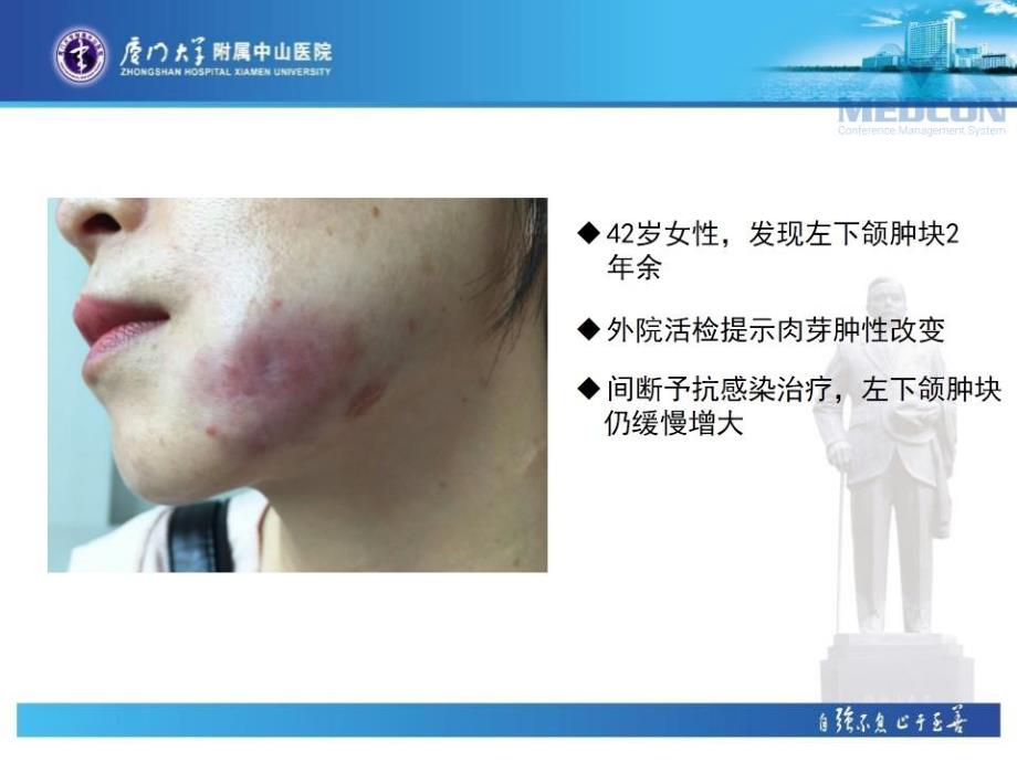 RosaiDorfman病.ppt_第3页