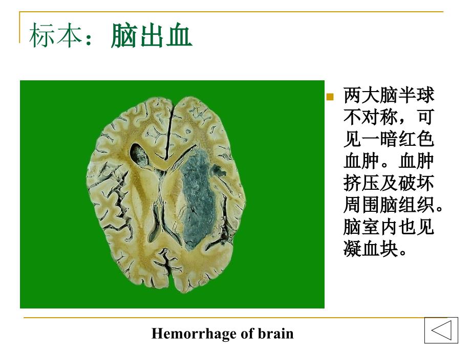 病理学实验大体标本有病理诊断.ppt_第3页