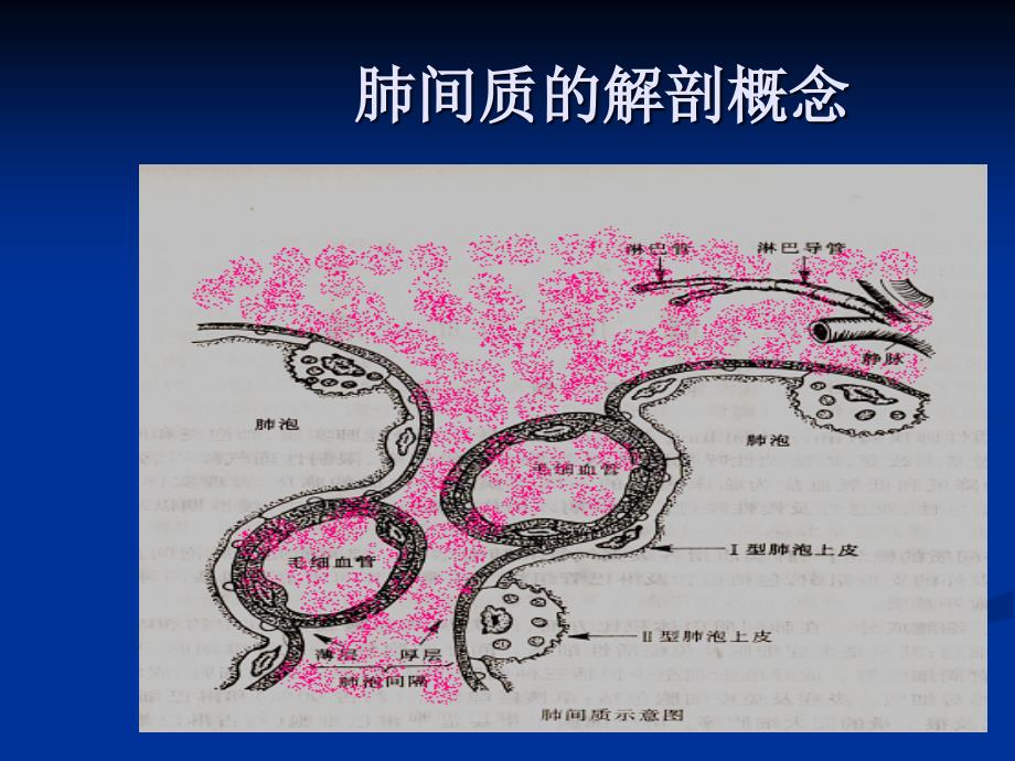特发性肺纤维化PPT课件.ppt_第3页