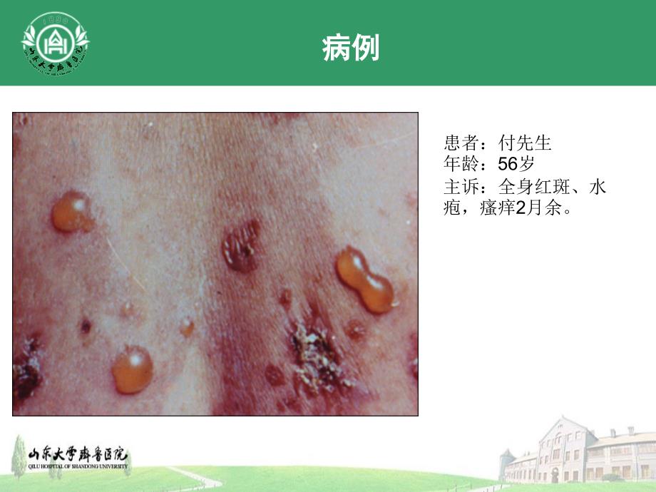 大疱性类天疱疮PPT课件.ppt_第2页