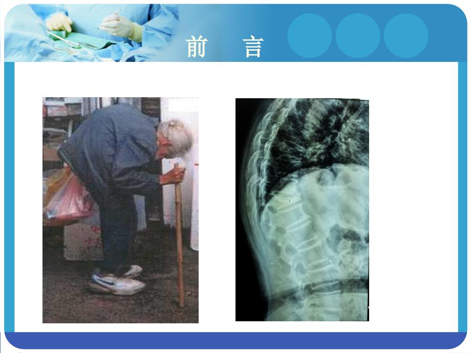 PKP术后护理.ppt_第3页