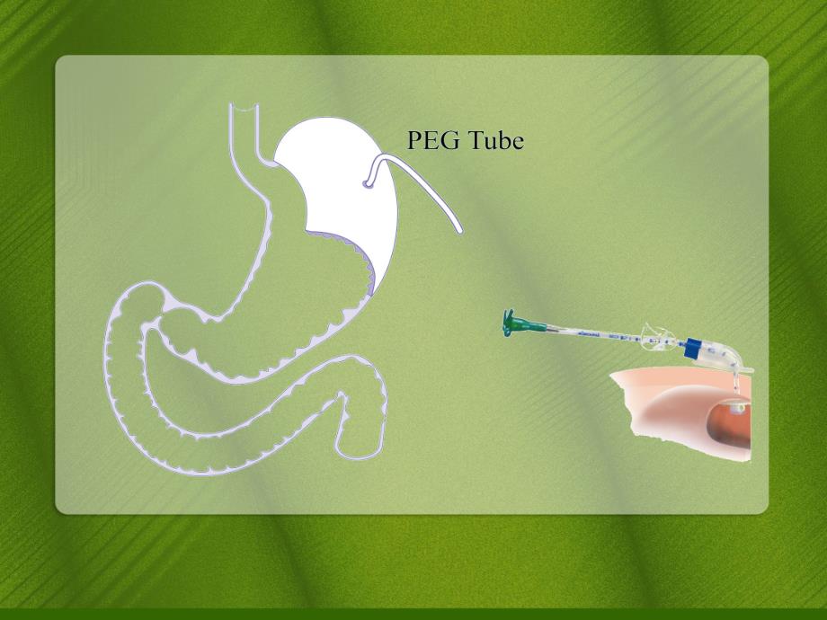 PEG经皮胃造瘘术的护理.ppt_第3页