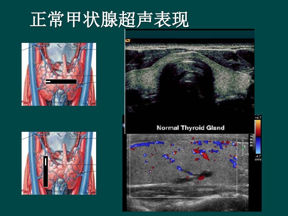甲状腺癌的超声检查.ppt_第2页