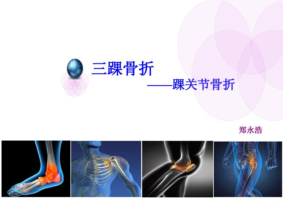 三踝骨折PPT课件.ppt_第1页