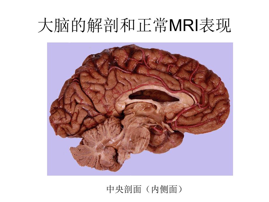 大脑的解剖和正常MRI表现.ppt_第3页