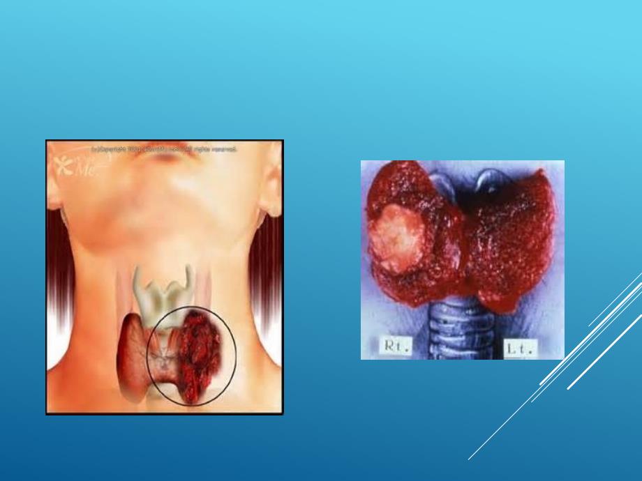 甲状腺TIRADS分类课件.ppt_第2页
