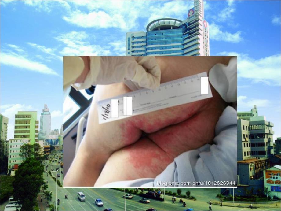 失禁性皮炎的护理PPT课件.ppt_第3页