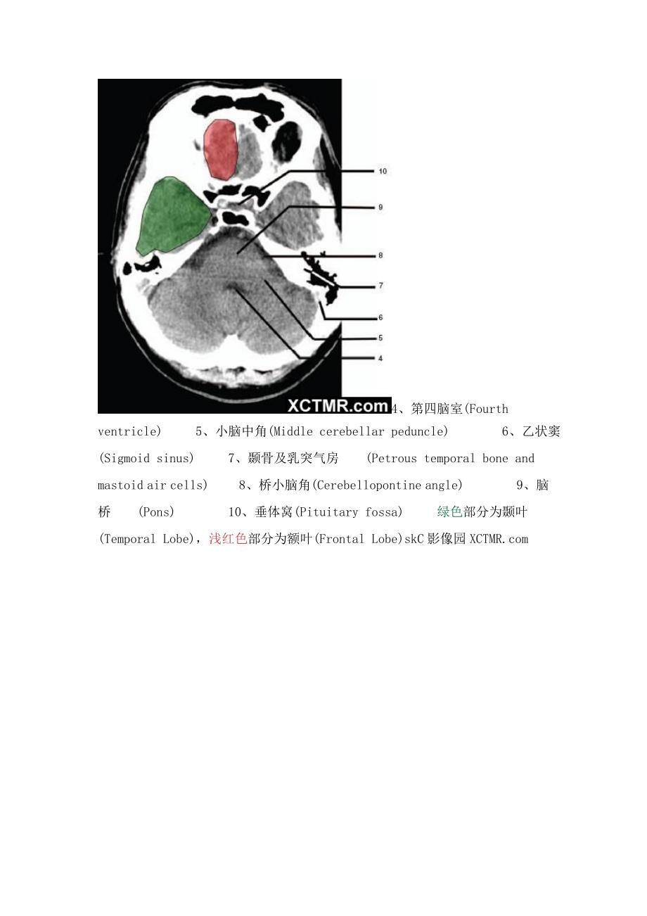 一起学CT之头颅CT.doc_第2页