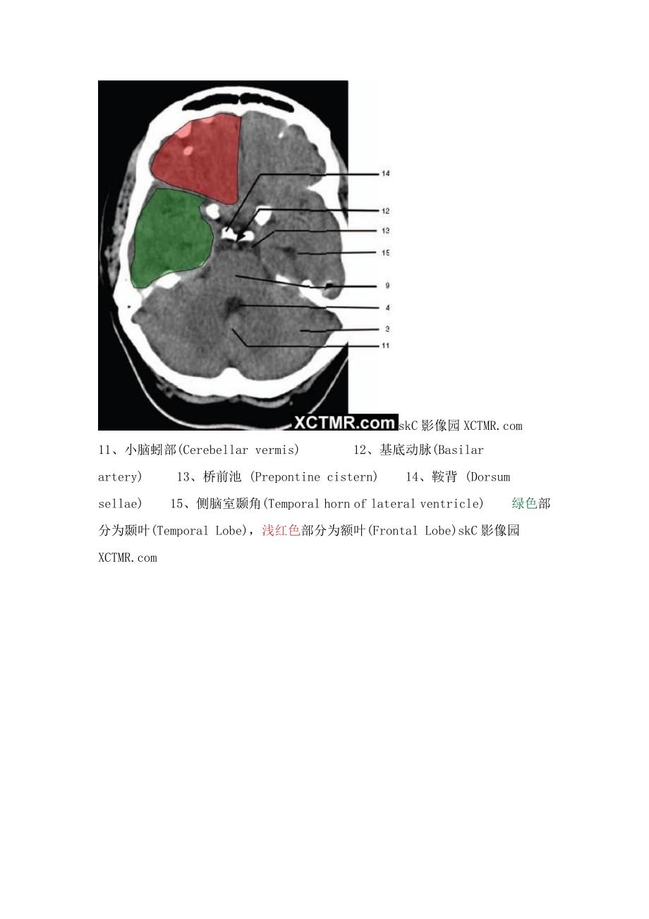 一起学CT之头颅CT.doc_第3页