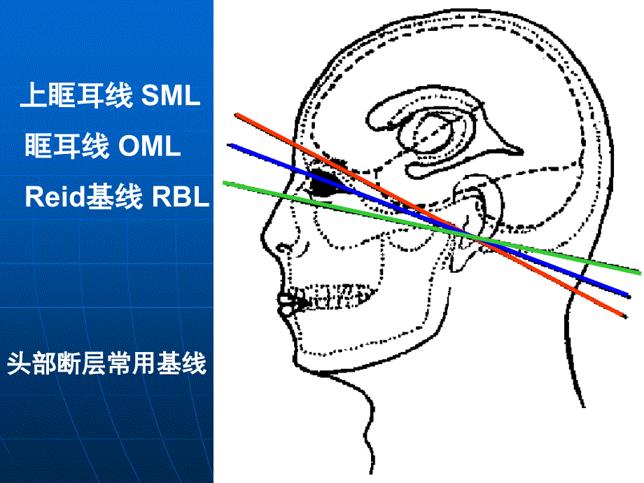 头颅CT解剖及诊断.ppt_第3页