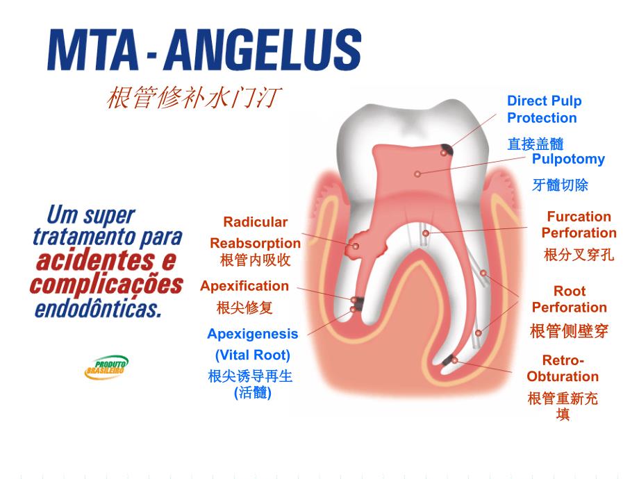 ProrootMTA的临床应用.ppt_第3页