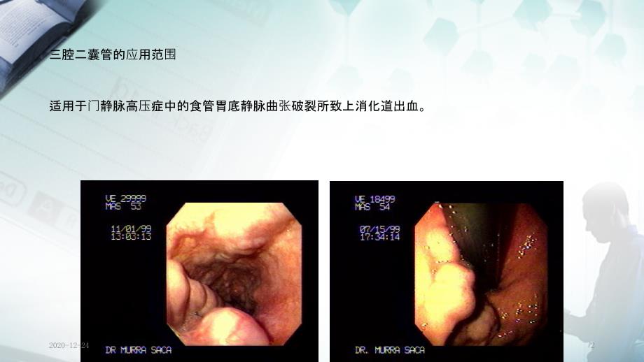 三腔二囊管实用课件.ppt_第2页