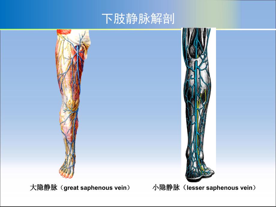 大隐静脉曲张剥脱术.ppt_第3页