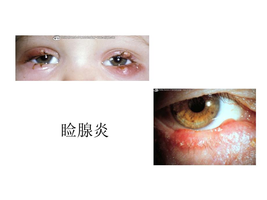 眼科学疾病图谱.ppt_第2页