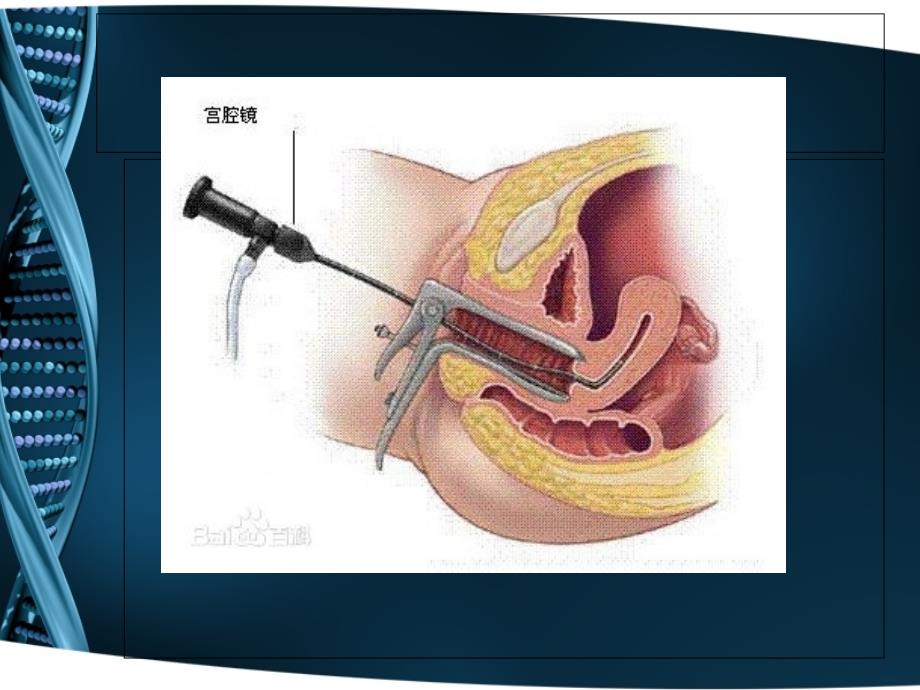 宫腔镜术后护理.ppt_第2页