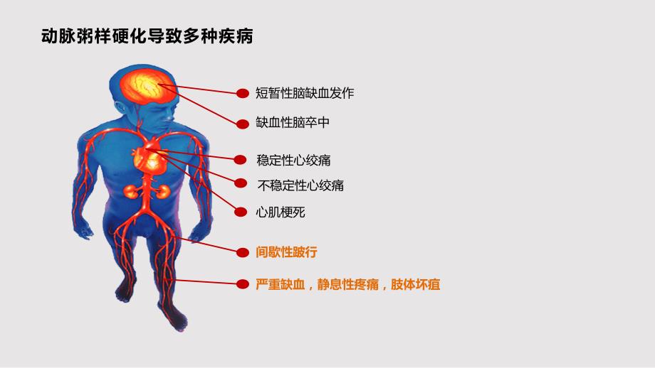 下肢动脉硬化闭塞症PPT课件.pptx_第2页