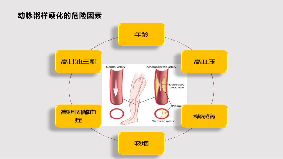 下肢动脉硬化闭塞症PPT课件.pptx_第3页