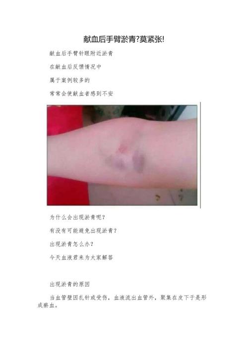 献血后手臂淤青莫紧张！.docx